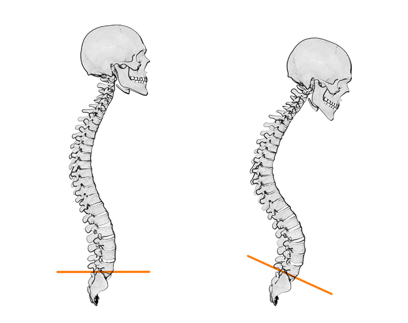Poor Posture and How to Overcome It